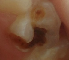 PATOLOGIA PULPAR Y PERIAPICAL EN DIENTES DECIDUOS