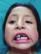 PATOLOGIA PULPAR Y PERIAPICAL EN DIENTES DECIDUOS