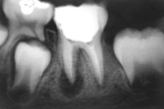 PATOLOGIA PULPAR Y PERIAPICAL EN DIENTES DECIDUOS