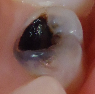 PATOLOGIA PULPAR Y PERIAPICAL EN DIENTES DECIDUOS