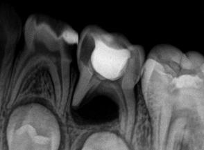 PATOLOGIA PULPAR Y PERIAPICAL EN DIENTES DECIDUOS