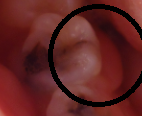 PATOLOGIA PULPAR Y PERIAPICAL EN DIENTES DECIDUOS