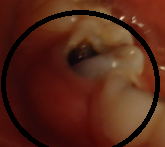 PATOLOGIA PULPAR Y PERIAPICAL EN DIENTES DECIDUOS