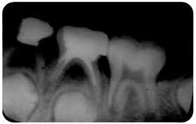 PATOLOGIA PULPAR Y PERIAPICAL EN DIENTES DECIDUOS