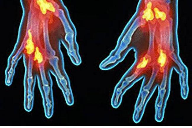 Aprendices con Necesidades Fisicas Especiales y con deterioros en la Salud