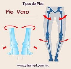 Aprendices con Necesidades Fisicas Especiales y con deterioros en la Salud