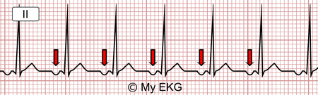Trastornos de la frecuencia y el ritmo cardiaco