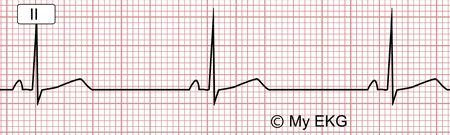 Trastornos de la frecuencia y el ritmo cardiaco