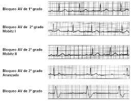Trastornos de la frecuencia y el ritmo cardiaco