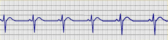 Trastornos de la frecuencia y el ritmo cardiaco