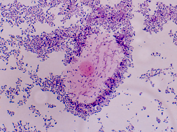 DOLOR PÉLVICO Y DISMENORREA. INFECCIONES GENITOURINARIAS Y ENFERMEDADES SEXUALMENTE