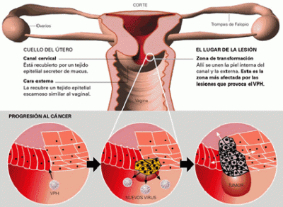 ENFERMEDAD INTRAEPITELIAL DE CERVIX, VAGINA Y VULVA