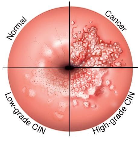 ENFERMEDAD INTRAEPITELIAL DE CERVIX, VAGINA Y VULVA