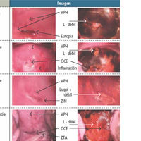 ENFERMEDAD INTRAEPITELIAL DE CERVIX, VAGINA Y VULVA