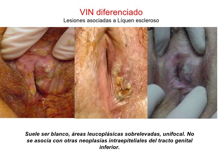 ENFERMEDAD INTRAEPITELIAL DE CERVIX, VAGINA Y VULVA