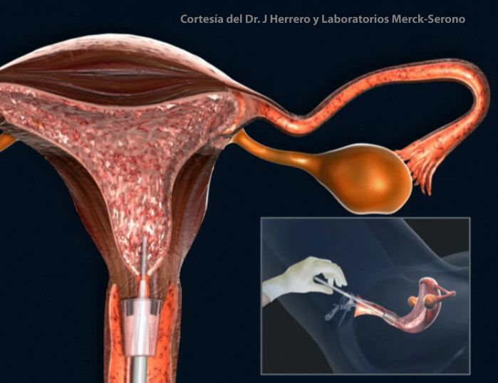 INFERTILIDAD, ABORTO TEMPRANO ESPONTANEO Y RECURRENTE