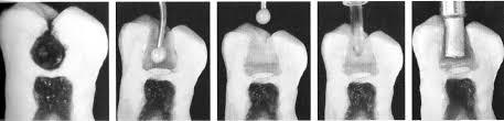 PROTOCOLO PARA TERAPIA PULPAR EN DIENTES TEMPORALES