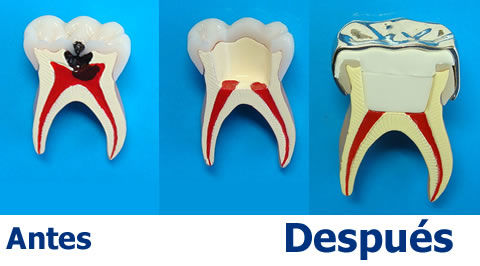 PROTOCOLO PARA TERAPIA PULPAR EN DIENTES TEMPORALES