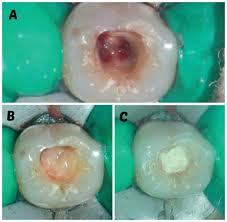 PROTOCOLO PARA TERAPIA PULPAR EN DIENTES TEMPORALES