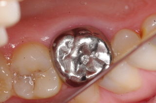 PROTOCOLO PARA TERAPIA PULPAR EN DIENTES TEMPORALES