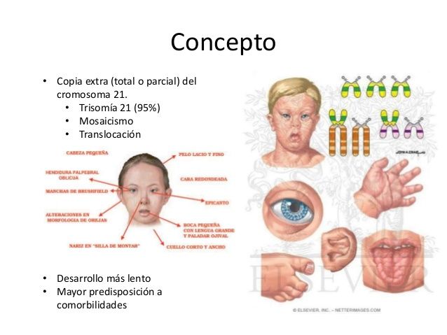 El desarrollo psicomotor en los niños con síndrome de Down y la intervención de fisioterapia