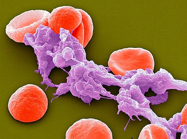 TRAMPAS EXTRACELULARES DE NEUTROFILOS ¿AMIGAS O ENEMIGAS?