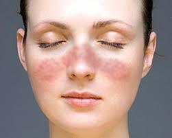 TRAMPAS EXTRACELULARES DE NEUTROFILOS ¿AMIGAS O ENEMIGAS?