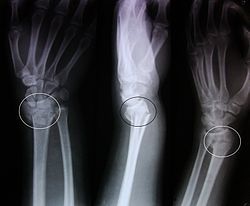 TRAUMATOLOGIA EN ANCIANOS