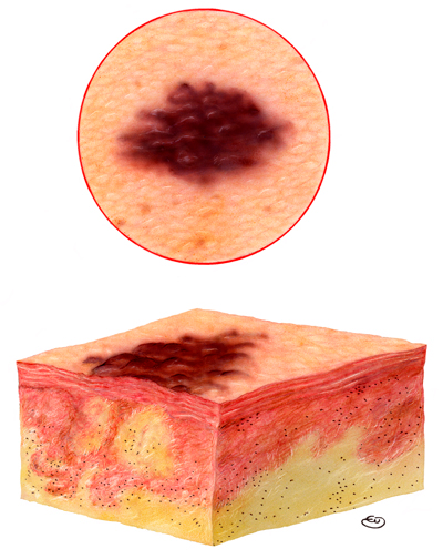 Xeroderma Pigmentoso