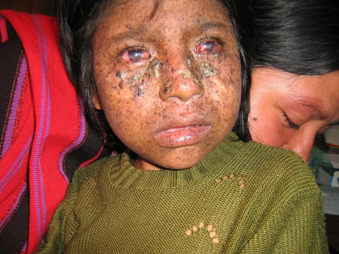 Xeroderma Pigmentoso