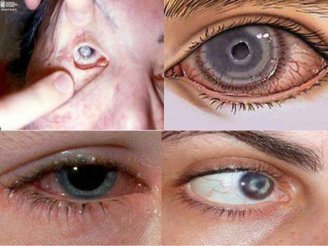 Xeroderma Pigmentoso