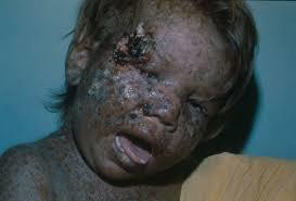 Xeroderma Pigmentoso