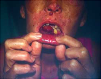 Xeroderma Pigmentoso