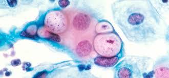 Medidas Preventivas para las Infecciones de Transmisión Sexual