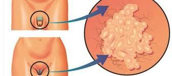 Medidas Preventivas para las Infecciones de Transmisión Sexual