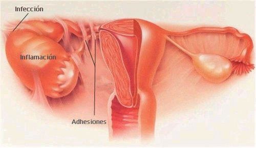 34. Enfermedades benignas del aparato reproductor femenino
