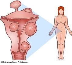 34. Enfermedades benignas del aparato reproductor femenino