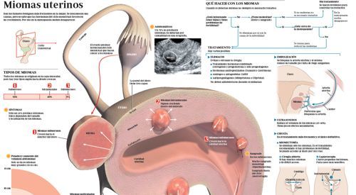 34. Enfermedades benignas del aparato reproductor femenino