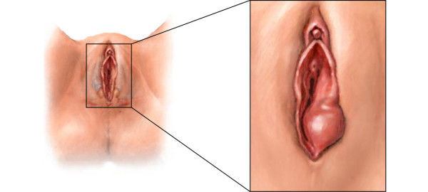 34. Enfermedades benignas del aparato reproductor femenino