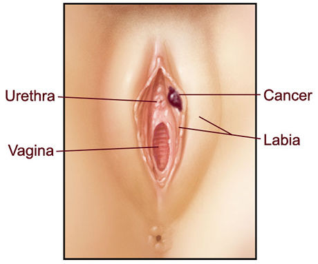 34. Enfermedades benignas del aparato reproductor femenino