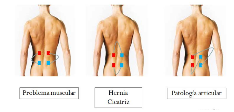 ANALGESIA CON CORRIENTE DE BAJA FRECUENCIA