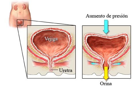 39. Incontinencia urinaria, prolapso genital, trastornos del piso pélvico