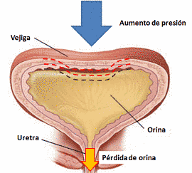 39. Incontinencia urinaria, prolapso genital, trastornos del piso pélvico