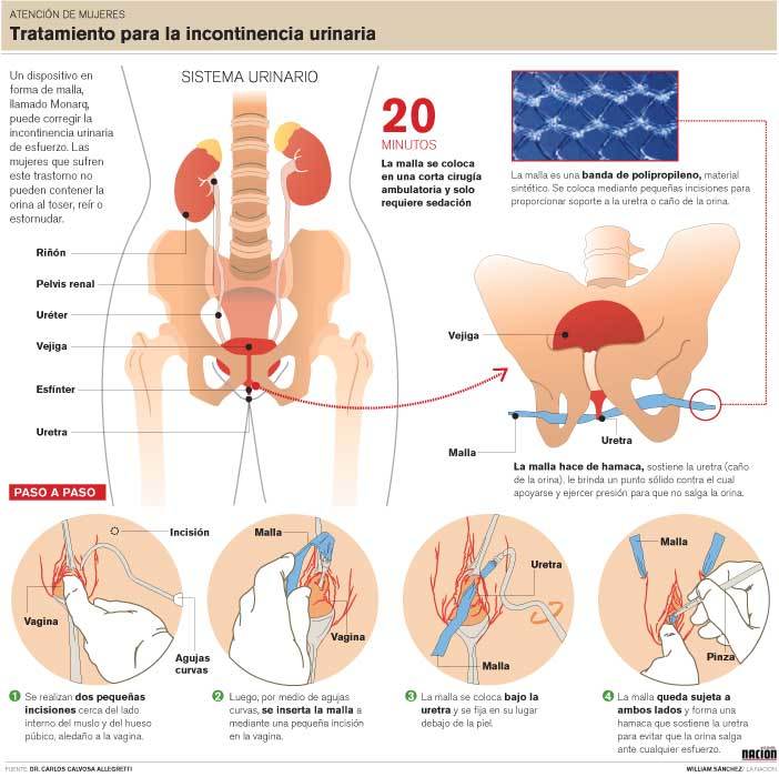 39. Incontinencia urinaria, prolapso genital, trastornos del piso pélvico