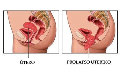 39. Incontinencia urinaria, prolapso genital, trastornos del piso pélvico