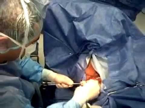 39. Incontinencia urinaria, prolapso genital, trastornos del piso pélvico
