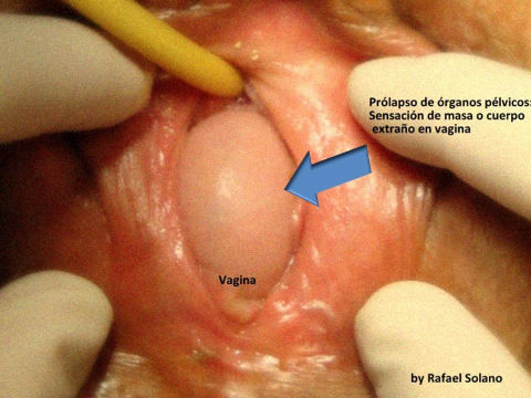 39. Incontinencia urinaria, prolapso genital, trastornos del piso pélvico