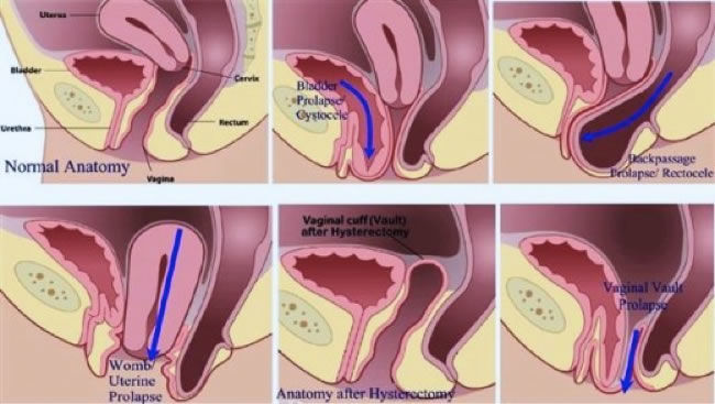 39. Incontinencia urinaria, prolapso genital, trastornos del piso pélvico