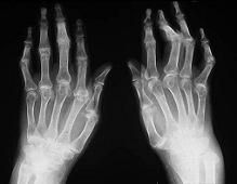 Trauma acumulativo