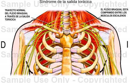 Trauma acumulativo